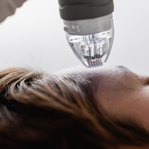 Microneedling-gesichtsbehandlung-in-Berlin-Dahlem-bei-Skinlifter